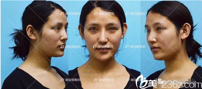 自體脂肪填充術前顯老 自體脂肪填充術前顯老