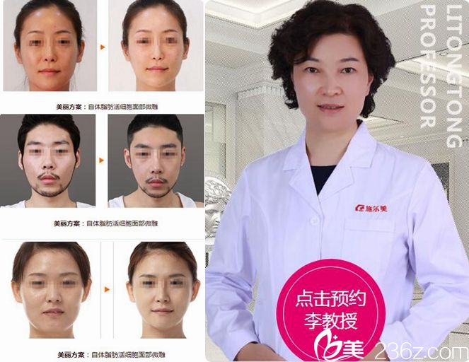 李彤彤自體脂肪面部填充案例 李彤彤自體脂肪面部填充案例