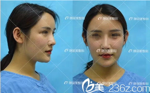 術后15天面部脂肪填充恢復 術后15天面部脂肪填充恢復