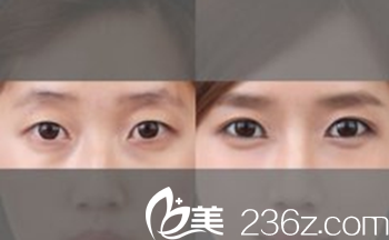 濟(jì)源市萍雙眼皮手術(shù)案例 濟(jì)源市萍雙眼皮手術(shù)案例