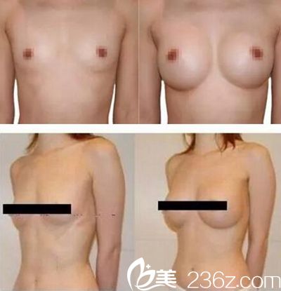 豐金德做的隆胸案例 豐金德做的隆胸案例