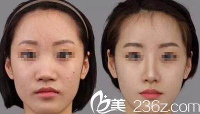 李卓然院長的注射美容案例 李卓然院長的注射美容案例