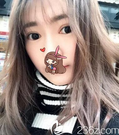 在<!--<i data=20240703-sp></i>-->整形割的雙眼皮 在<!--<i data=20240703-sp></i>-->整形割的雙眼皮