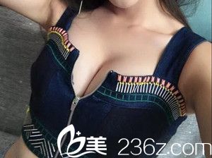 自體脂肪隆胸手術(shù)后20天效果