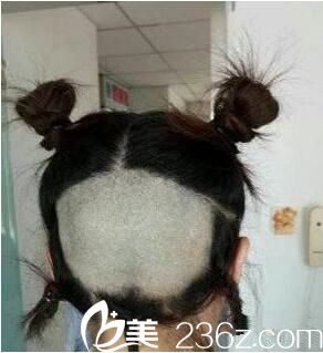 術(shù)前取發(fā)