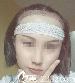 術(shù)后即刻效果