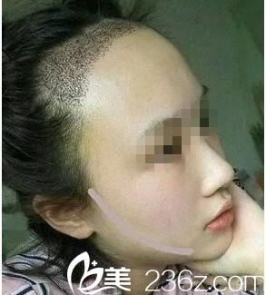 種植后一周效果