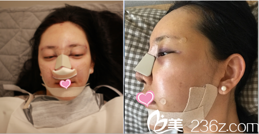 韓國德嘉整形外科金澤均隆鼻案例術(shù)后當(dāng)天照 韓國德嘉整形外科金澤均隆鼻案例術(shù)后當(dāng)天照