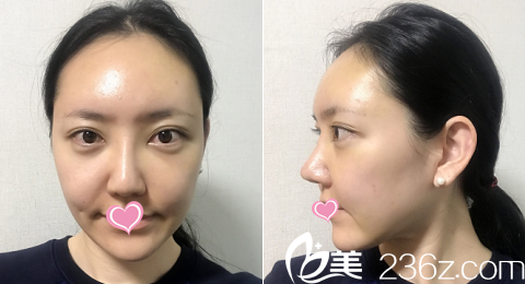 韓國德嘉整形外科醫(yī)院案例術(shù)后10天效果 韓國德嘉整形外科醫(yī)院案例術(shù)后10天效果