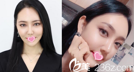 給你看我在韓國(guó)德嘉整形醫(yī)院找金澤均做硅膠隆鼻和面部脂肪填充2月效果