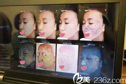 成都藝星Visia皮膚智能檢測Visia皮膚智能檢測結果