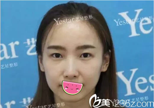 激光祛斑治療術后斑痂脫落效果