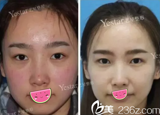 成都藝星激光祛斑術前術后對比效果