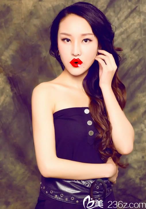 我叫吳玲，給大家講講在紹興維美做雙眼皮+隆鼻+豐下巴+瘦臉+祛斑系列手術(shù)歷程