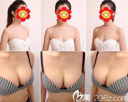 維多利亞劉中策自體脂肪隆胸案例對(duì)比圖 維多利亞劉中策自體脂肪隆胸案例對(duì)比圖