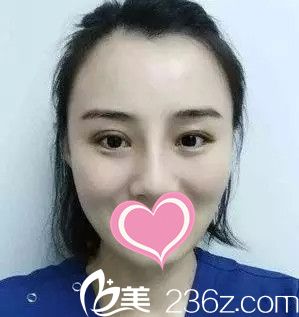 隆鼻手術(shù)后半個(gè)月恢復(fù)效果