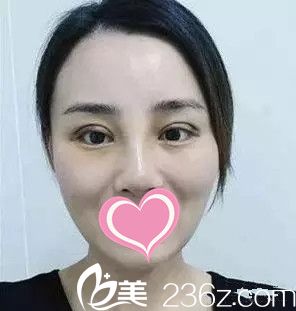 馬晶醫(yī)生雙眼皮手術(shù)案例