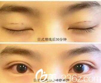 信陽金霞真人展示日式埋線雙眼皮手術過程 術后眼睛好看不止一點點