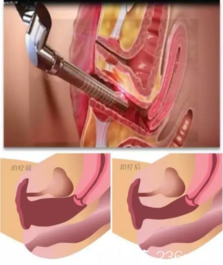 私密青春激光治療過程及效果示意圖