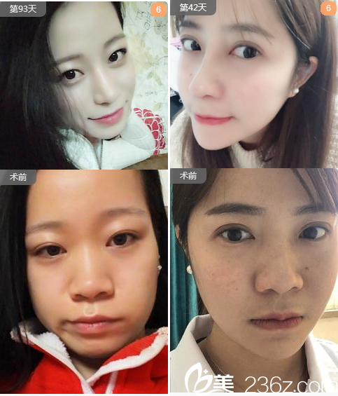 廣州曙光蔣思軍耳軟骨復(fù)合隆鼻和膨體隆鼻