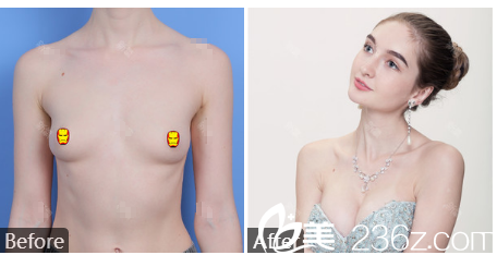 廣州曙光劉杰偉假體隆胸