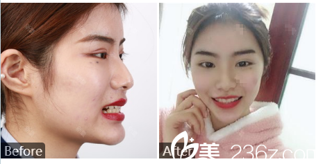 廣州曙光王浩做的牙齒矯正