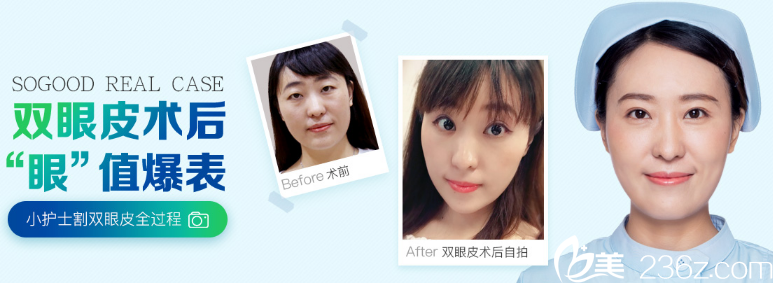 廣州曙光王娟雙眼皮