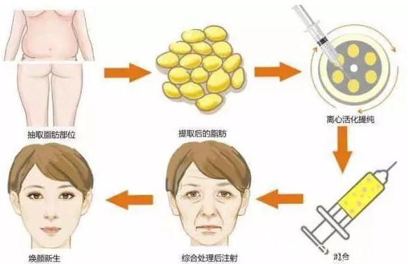 仁美面部脂肪填充