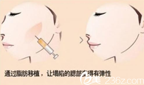 仁美面部脂肪填充的優(yōu)勢(shì)