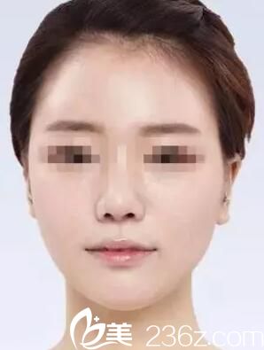 想了解柳州仁美楊克做面部自體脂肪填充效果好嗎？看小何術(shù)后2個月的變化