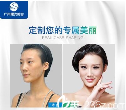 廣州曙光醫(yī)院萬友望醫(yī)生做的自體脂肪填充案例圖片 廣州曙光醫(yī)院萬友望醫(yī)生做的自體脂肪填充案例圖片