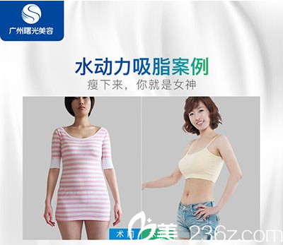 廣州曙光醫(yī)院萬友望主任做的吸脂案例圖片 廣州曙光醫(yī)院萬友望主任做的吸脂案例圖片