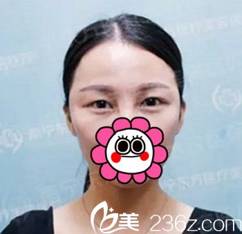 在南寧東方做雙眼皮手術(shù)前 在南寧東方做雙眼皮手術(shù)前