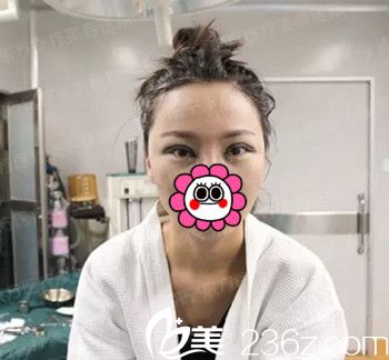 在南寧東方做雙眼皮手術(shù)后即刻效果 在南寧東方做雙眼皮手術(shù)后即刻效果