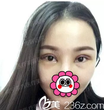 在南寧東方做雙眼皮手術(shù)后4天 在南寧東方做雙眼皮手術(shù)后4天