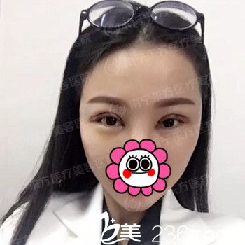 在南寧東方做雙眼皮手術(shù)5天 在南寧東方做雙眼皮手術(shù)5天