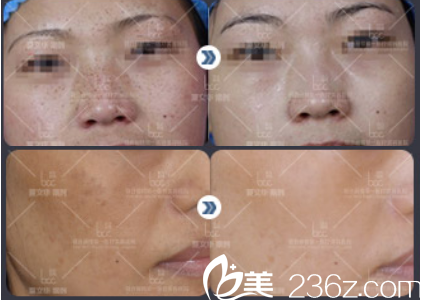 北京聯(lián)合麗格醫(yī)療美容醫(yī)院夏醫(yī)生案例 北京聯(lián)合麗格醫(yī)療美容醫(yī)院夏醫(yī)生案例