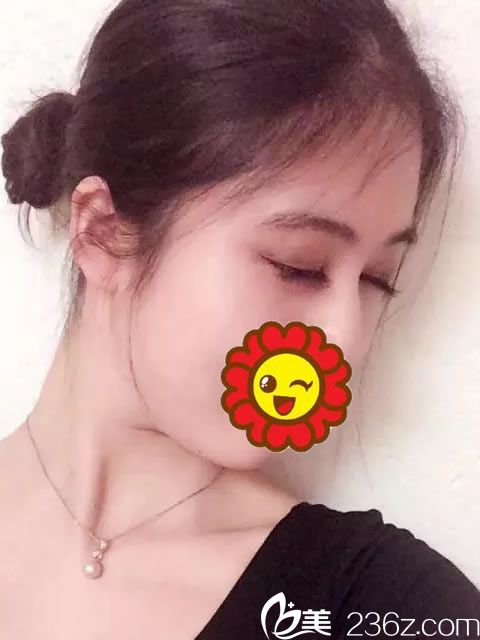 義烏張小紅雙眼皮案例閉眼效果 義烏張小紅雙眼皮案例閉眼效果