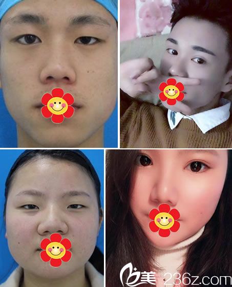 寧波時光美極張寶琳雙眼皮案例