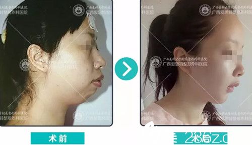 南寧愛思特頜面整形前后對比 南寧愛思特頜面整形前后對比