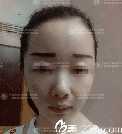 南寧愛思特頜面整形手術(shù)后1個月 南寧愛思特頜面整形手術(shù)后1個月