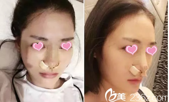 鄒琪醫(yī)生隆鼻案例