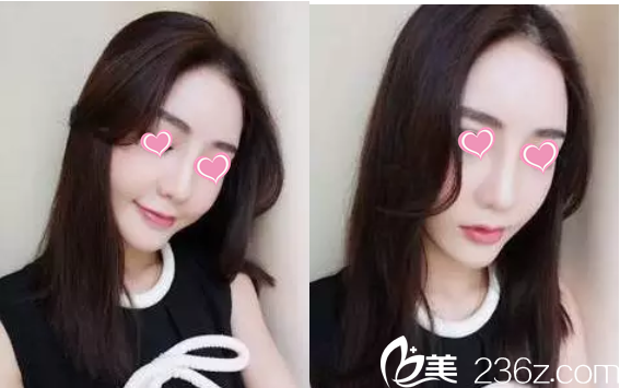 隆鼻后20天效果