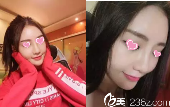 術(shù)后一個(gè)月