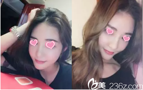 在做的鼻子術(shù)后三個(gè)月了，美成了小仙女