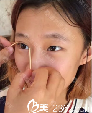 我在大同清木做雙眼皮和開眼角術(shù)前照 我在大同清木做雙眼皮和開眼角術(shù)前照