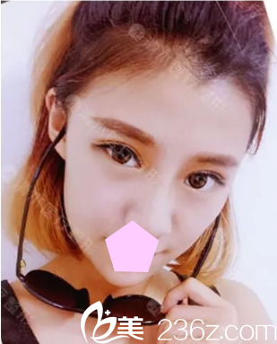 高考結(jié)束后老媽帶我到大同清木整形找姜際珠醫(yī)生做了雙眼皮+開眼角，來看看恢復(fù)效果怎么樣