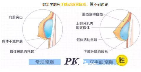 傳統(tǒng)隆胸與雙平面隆胸方式對(duì)比 傳統(tǒng)隆胸與雙平面隆胸方式對(duì)比