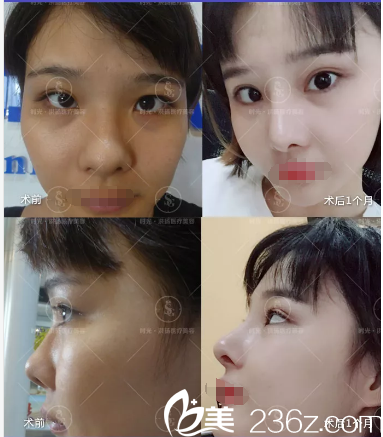 曹洪揚院長鼻綜合+上瞼下垂案例 曹洪揚院長鼻綜合+上瞼下垂案例