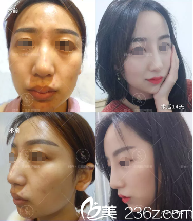 曹洪揚院長自體脂肪填充案例 曹洪揚院長自體脂肪填充案例